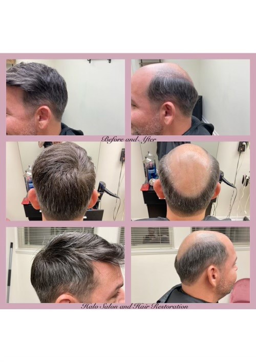 Hair Replacement Transformation